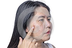 Close up of Asian adult woman face has freckles, large pores, blackhead pimple and scars problem from not take care for a long