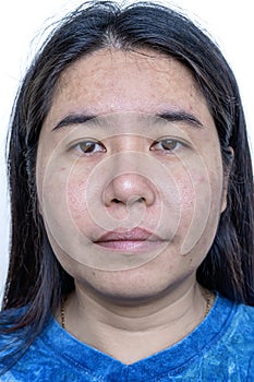 Close up of Asian adult woman face has freckles, large pores, blackhead pimple and scars problem from not take care for a long tim