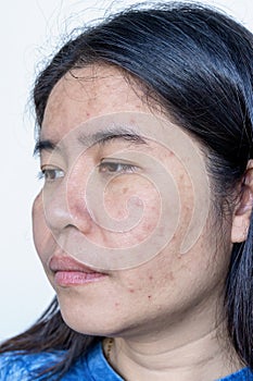 Close up of Asian adult woman face has freckles, large pores, blackhead pimple and scars problem from not take care for a long tim