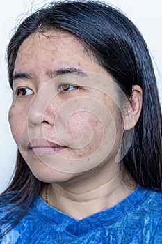 Close up of Asian adult woman face has freckles, large pores, blackhead pimple and scars problem from not take care for a long tim