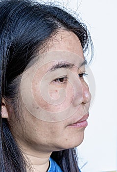 Close up of Asian adult woman face has freckles, large pores, blackhead pimple and scars problem from not take care for a long tim