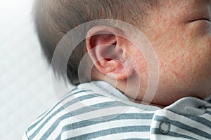 Close up Asian Newborn baby boy with Common skin rash on his face