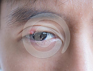 Close up of Asian young man with brown eye with stye infection. Eyelid abscess, hordeolum in medical health, disease and treatment