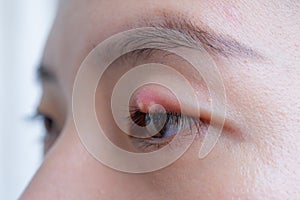 Close up of Asian young woman with brown eye with stye infection. Eyelid abscess, hordeolum in medical health, disease and