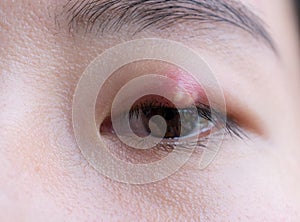 Close up of Asian young woman with brown eye with stye infection. Eyelid abscess, hordeolum in medical health, disease and