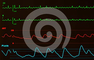 Close Up of Atrial Flutter on Monitor with Black Screen