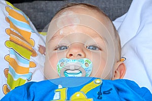 Close up of baby injury. Baby`s expression and the scar on the forehead after he hits his head on the ground