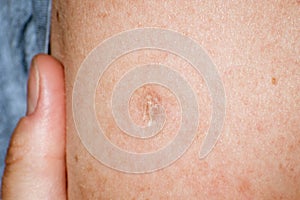 Close up of Bacillus Calmette-GuÃÂ©rin BCG vaccine scar mark in the upper left arm of an adult person; BCG vaccine is usually photo