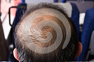 Close-up of balding and thinning hair of man revealing scalp