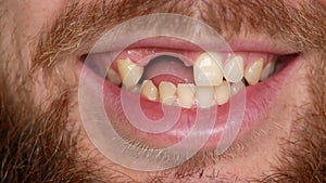 Close-up of a bearded man. He turns his head into a frame and smiles. The guy`s teeth are broken