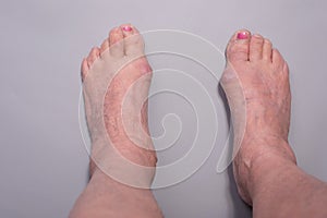 close-up of big toe disease curvature in elderly woman on gray background