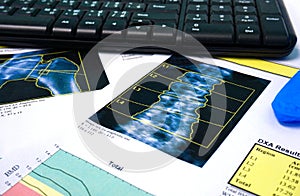 Close up Bone Densitometry Result on the table in room doctor