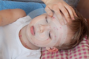 Close up boy with chickenpox