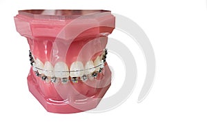 Dental braces model