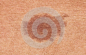 Close-up of brown birthmark
