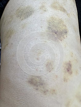 Close-up of bruises on a woman's leg. Physical damage, gender violence