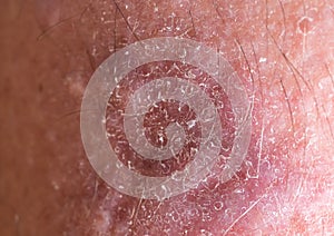 Close-up of bumpy skin with blemishes and scaly epidermis, dermatology and skin diseases