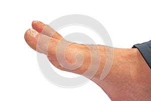 Close up a callus on man`s foot. Callus is common foot problem isolated on white background.