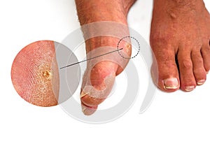 Close up a callus on man`s foot. Callus is common foot problem isolated on white background.