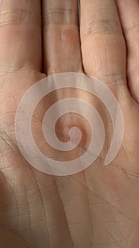 Close up of calluses on the palms