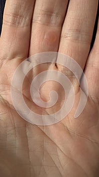 Close up of calluses on the palms