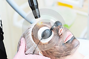 Close-up carbon face peeling procedure. Laser pulses clean skin of the face. Hardware cosmetology treatment. Process of