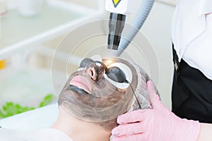 Close-up carbon face peeling procedure. Laser pulses clean skin of the face. Hardware cosmetology treatment. Process of photo