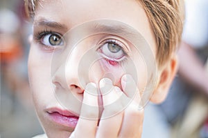 Close up of a child eye stye. Ophthalmic hordeolum disease.