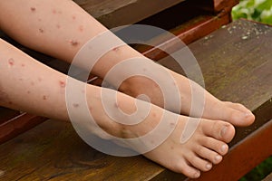 Close-up of children`s legs strewn with ulcers and sores, combed from insect bites photo