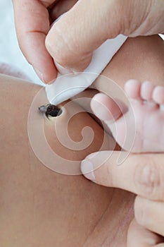 Close up cleaning umbilical cord of newborn