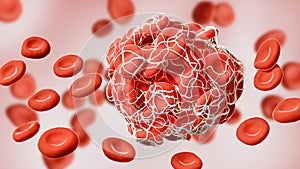 Close-up of a coagulated clot of red blood cells entangled in fibrin 3D rendering illustration. Thrombus, thrombosis, blood