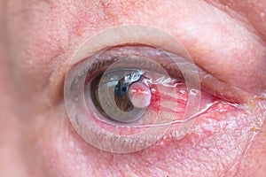 Close up of the conjunctiva squamous cell carcinoma. photo