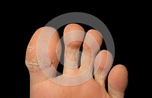 Close up of cracked foot fingers of human skin isolated on back background in medical healthcare treatment concept