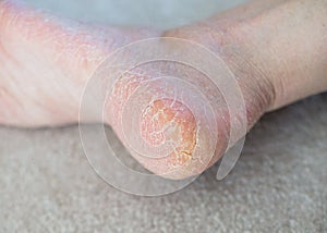 Close up cracked heels. Health problems with skin on feet