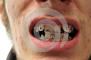 Close up of crooked teeth with braces