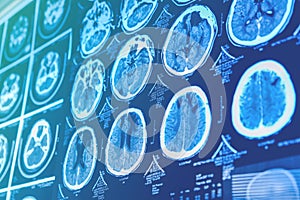 Close-up of CT scan with brain. Medicine, science and education MRI brain background. Magnetic resonance imaging. Tomography shot