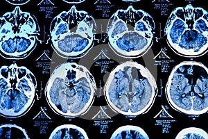 Close-up of CT scan with brain. Medicine, science and education MRI brain background. Magnetic resonance imaging. Tomography shot