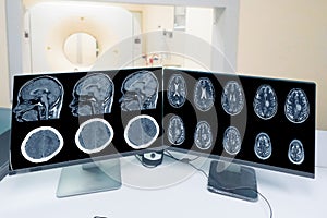 Close up CT-scan control room and showing brain image meningioma in brain CT scan room background, Medical healthcare.