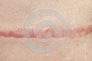 Close up of cyanotic keloid scar caused by surgery and suturing, skin imperfections or defects. Hypertrophic Scar on skin,