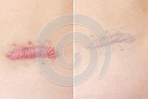 Close up of cyanotic keloid scar caused by surgery and suturing, skin imperfections or defects before and after treatment and