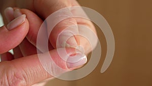 Close-up of a damaged nail on a woman's hand, onycholysis.