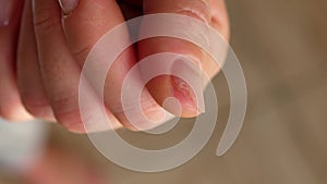 Close-up of a damaged sawn nail on a woman's hand, onycholysis. Podologist.