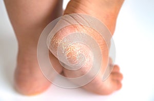 Close up Dehydrate skin dry foot cracks skin rough skin