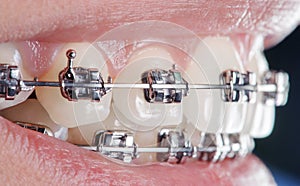 Close-up dental braces on teeth. Orthodontic Treatment