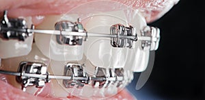 Close-up dental braces on teeth. Orthodontic Treatment