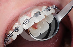 Close-up dental braces on teeth. Orthodontic Treatment