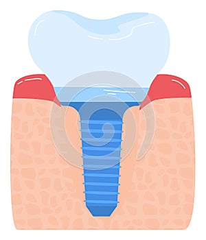 Close-up of a dental implant in the jawbone showing structure and gums. Detailed anatomy of tooth replacement. Medical photo