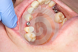 Close-up dental implant wort patient in a dental clinic during treatment. The concept of surgical aesthetic dentistry