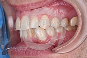 Close up dental problem sick teeth dentist examination before treatment fixator