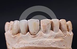 Close up of dental prothetic jaw.